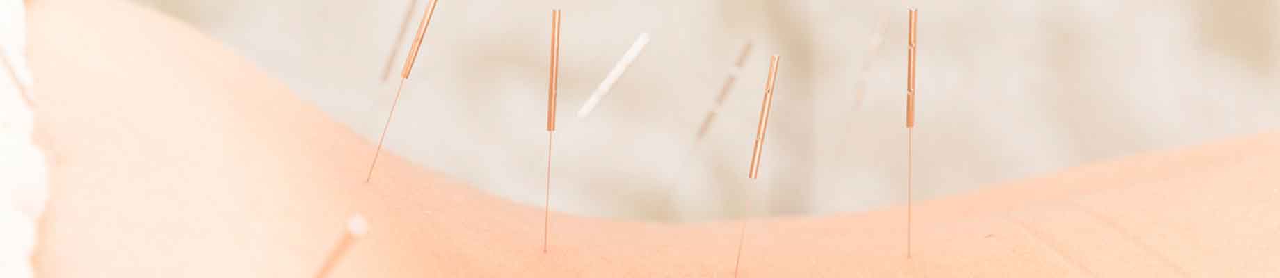 Acupuncture Plymouth | Acupuncture for Injury Plymouth | Acupuncturist Plymouth