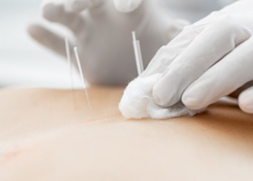 Acupuncture Plymouth | Acupuncture for Injury Plymouth | Acupuncturist Plymouth