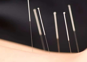 Acupuncture Plymouth | Acupuncture for Injury Plymouth | Acupuncturist Plymouth