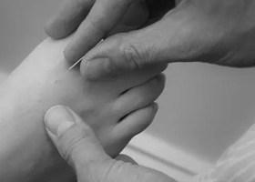 Acupuncture Plymouth | Acupuncture for Injury Plymouth | Acupuncturist Plymouth